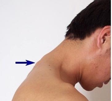 颈椎自我复位怎么做,颈椎变直自我矫正法