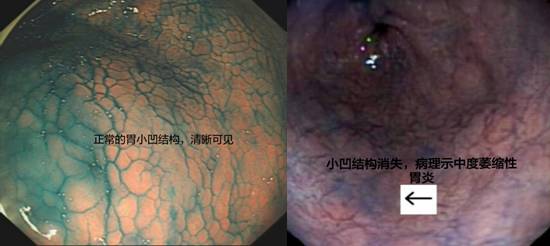 精细胃镜检查（二）——色素内镜（上）