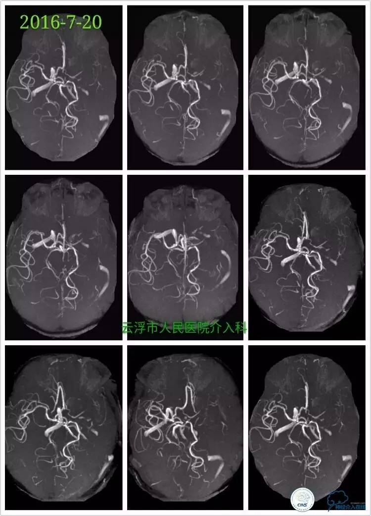 脑血管介入培训基地,脑卒中血管介入治疗