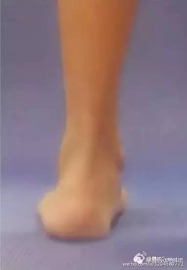 扁平足矫正训练法,扁平足物理治疗能不能恢复足弓