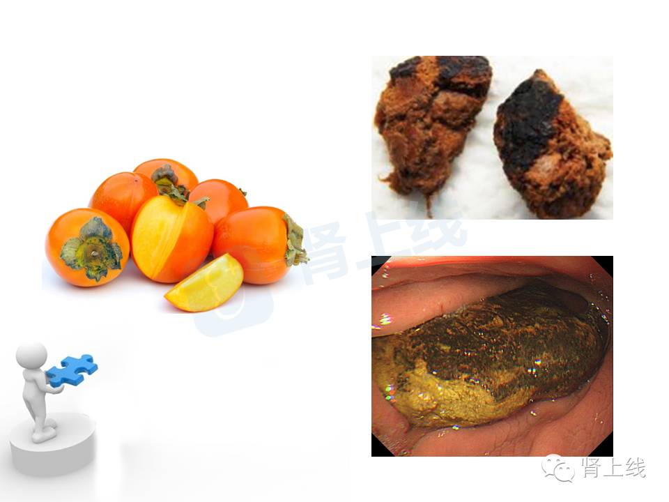 吃山楂取出胃结石,吃10个山楂胃结石有多少