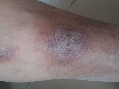 中医治疗精索静脉曲张药方,下肢静脉曲张的中西医治疗