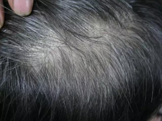 少白头怎么变黑小百科来普及