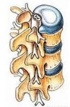 有关脊髓血管畸形的描述,脊髓血管畸形手术后能恢复行走吗