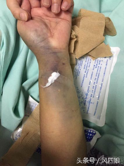 动脉采血后皮下出血怎么处理,动脉血管血肿如何消除