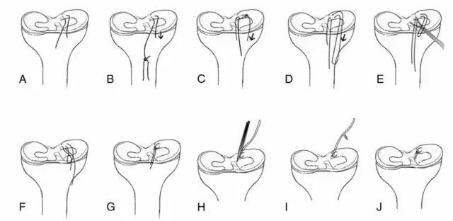 半月板撕裂微创手术术后恢复教程,半月板桶柄状撕裂修复缝合术