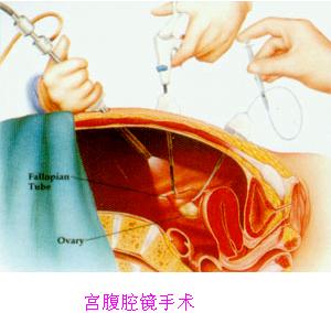 腹腔镜检查什么原理,腹腔镜的检查都有什么