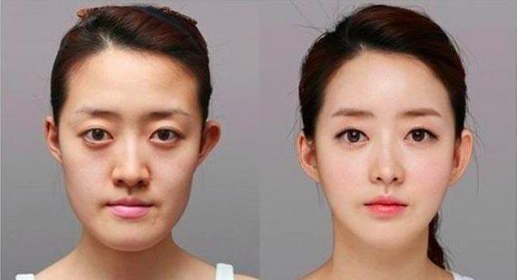 下颌角决定自己的颜值,下颌线决定颜值