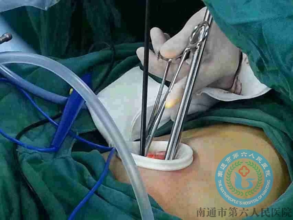 胸腔微创手术注意事项,胸腔手术是几类切口