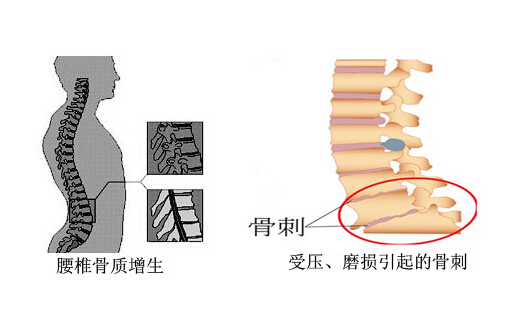 腰椎骨质增生的最好治疗办法,腰椎骨质增生怎么治疗最快最有效
