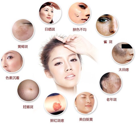 黑色素提取祛斑和激光祛斑哪个好,彩光祛斑和激光祛斑的区别是什么