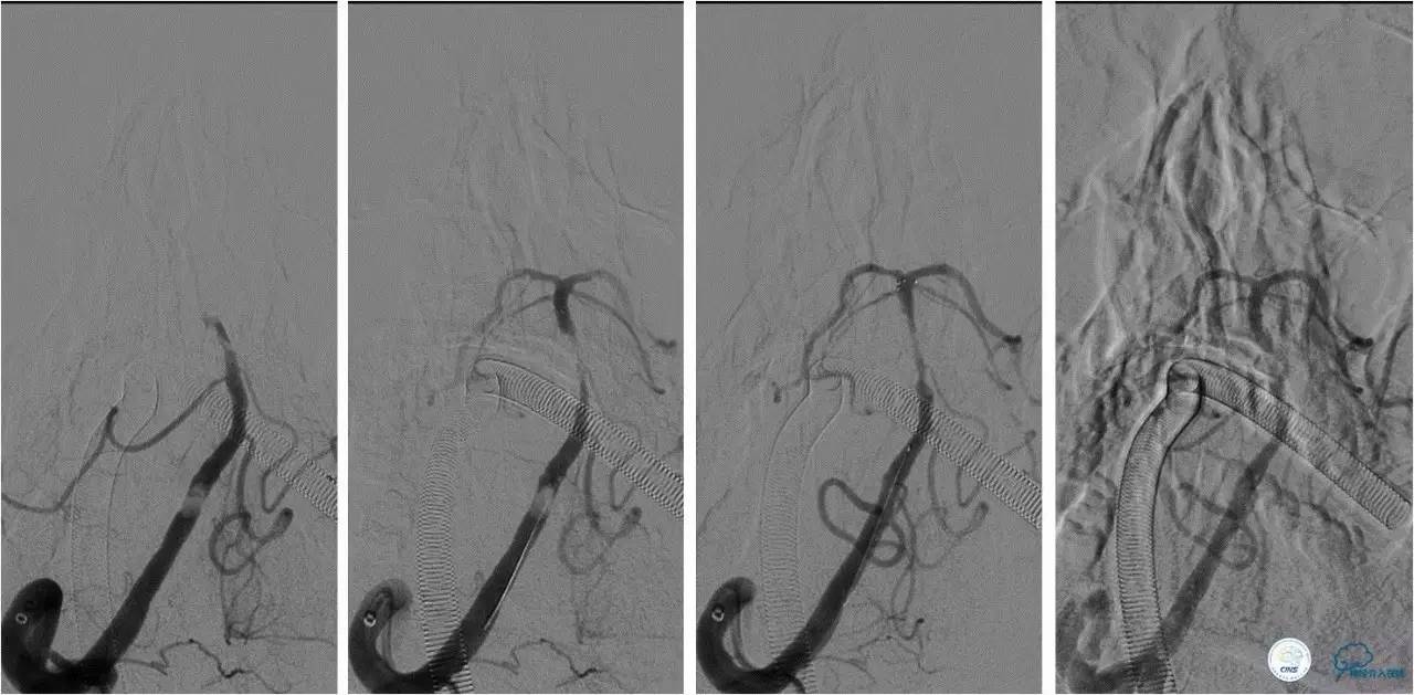 后循环系统梗死,后循环梗死