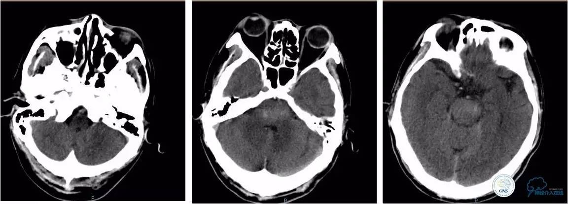 后循环系统梗死,后循环梗死