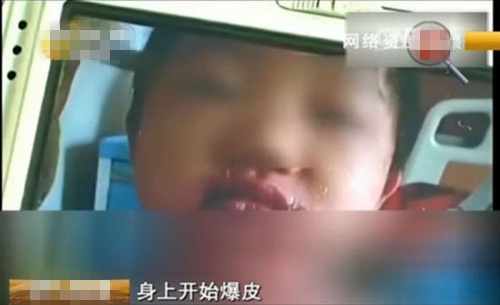 儿童玩泡泡水脸上过敏,儿童玩泡泡液皮肤发红