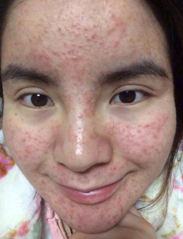 过敏性痘痘如何杀菌消炎,湿疹痘痘是怎样形成的