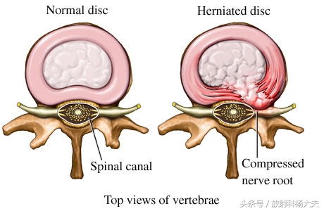 除了腰间盘突出其它哪儿都不突出,椎间盘膨出和脱出的区别