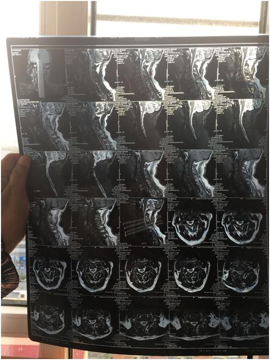 颈椎管狭窄头晕有效的中成药,颈椎管狭窄问诊