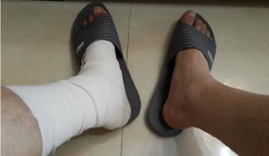 脚扭了肿了鼓包了怎么处理,脚刚扭了应该可以先怎么处理