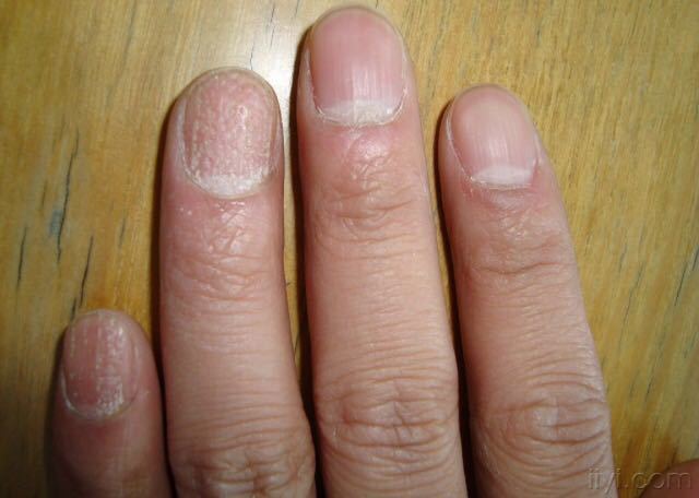 小孩手指甲分成两层是怎么回事,灰指甲指甲盖分离是好事还是坏事