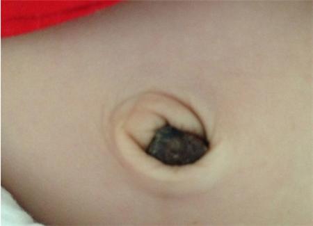 孕妇肚脐黑色污垢怎么清理,新生儿肚脐每天都要清理吗