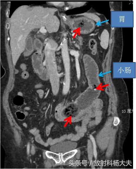 吃下2块钱的柿子,却要去医院花两千块把它从肠子里弄出来