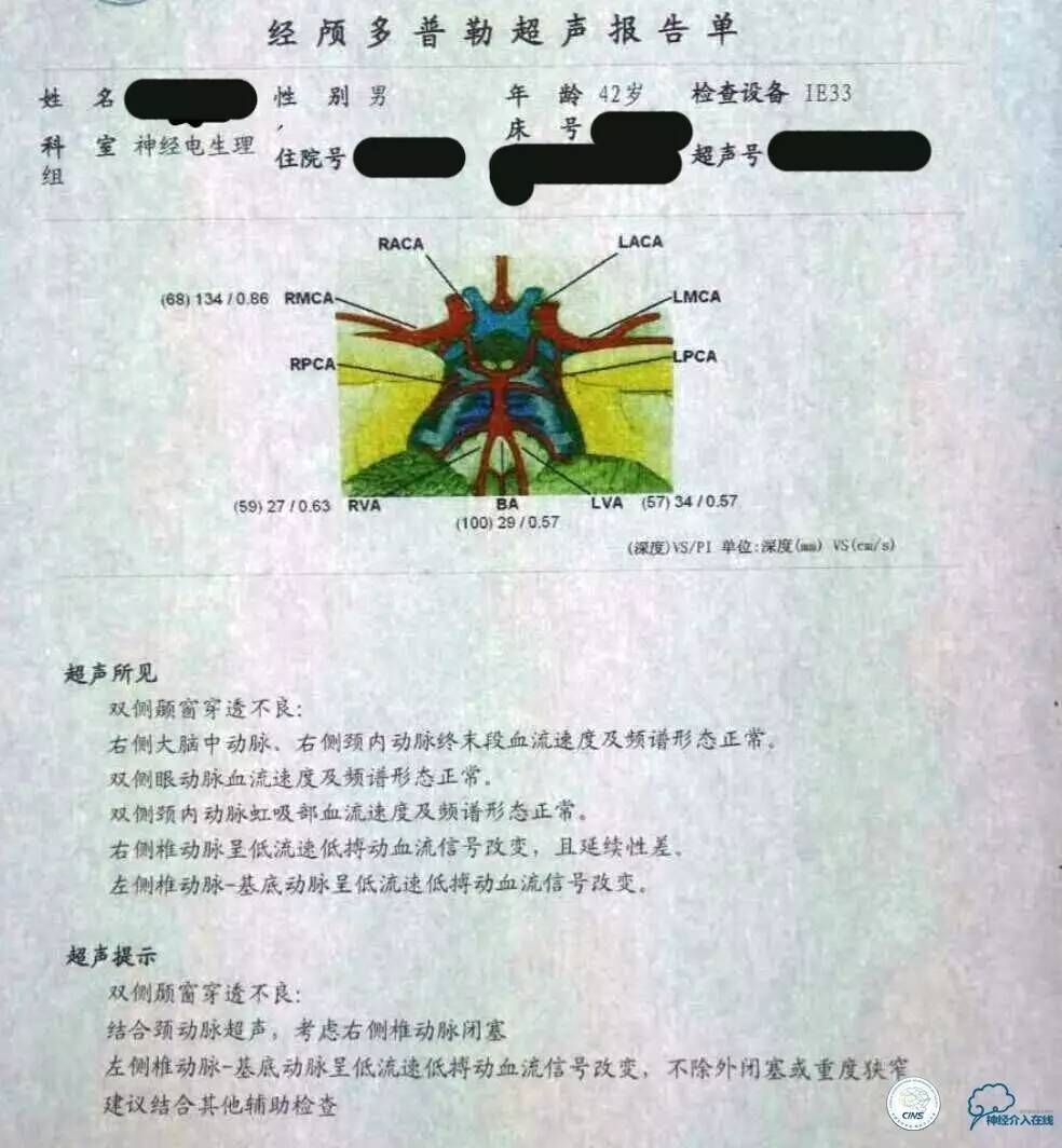 天坛周记|左椎V4段-基底动脉交界区狭窄的支架治疗