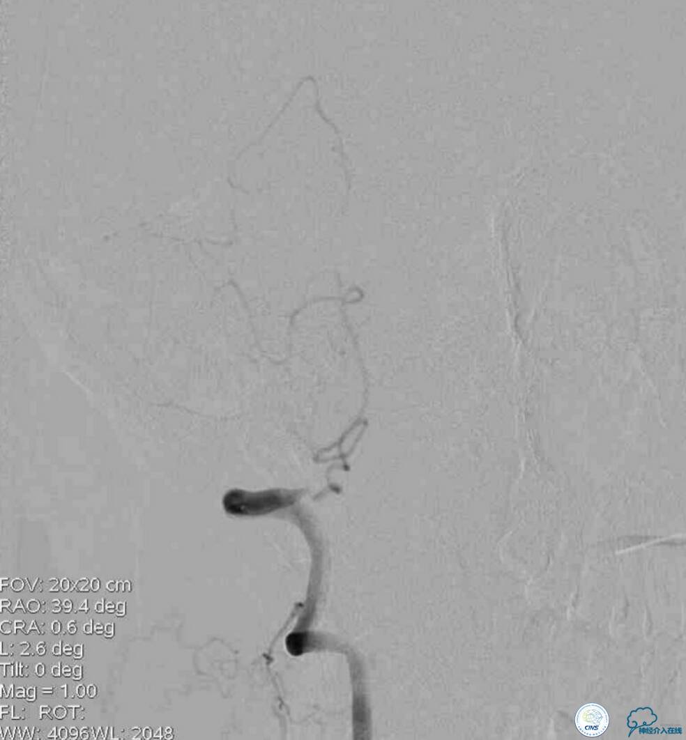 天坛周记|右椎动脉V4段慢性闭塞血管内介入治疗再通一例