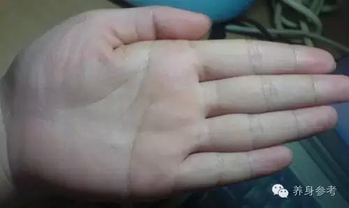 讲解脑血栓疾病的4大预防绝招,脑血栓患者秋天要注意什么