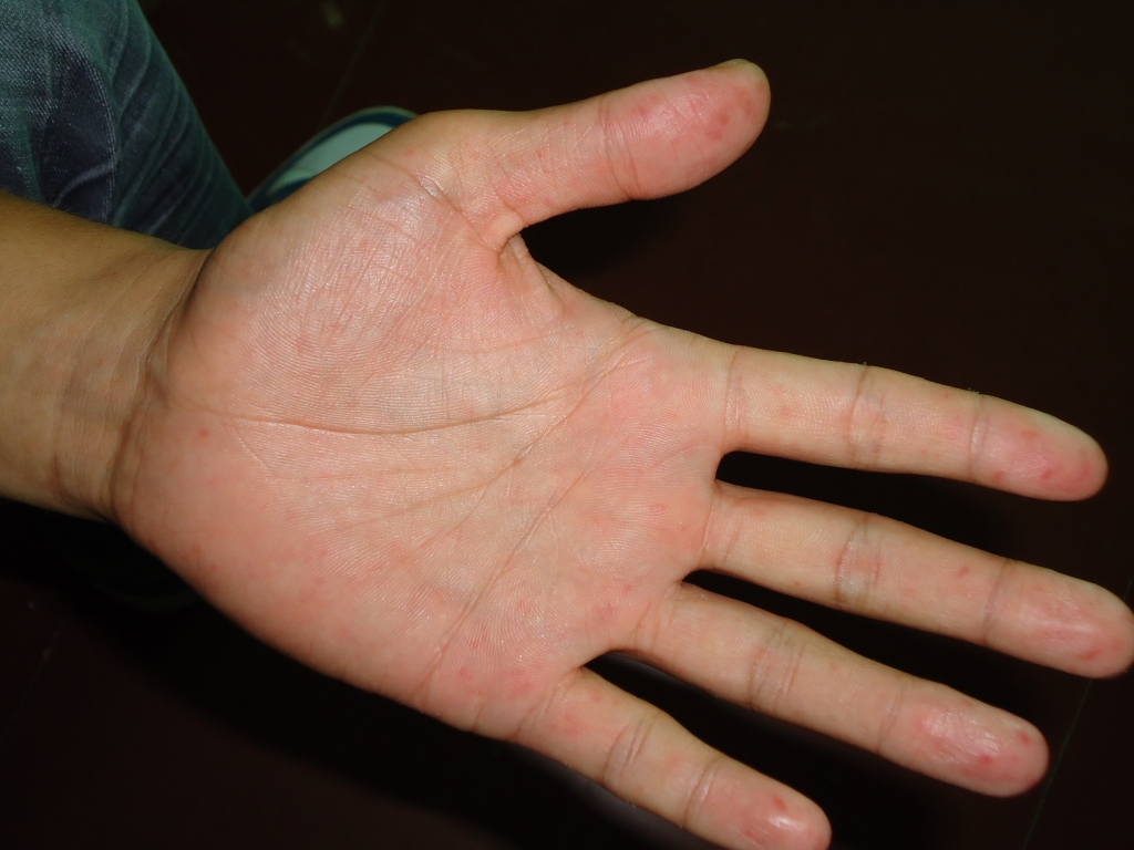 宝宝手足口低烧怎么处理,幼儿手足口病症状敷什么药