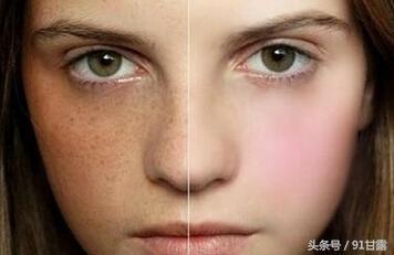 你有雀斑黄褐斑吗,脸黄长褐斑