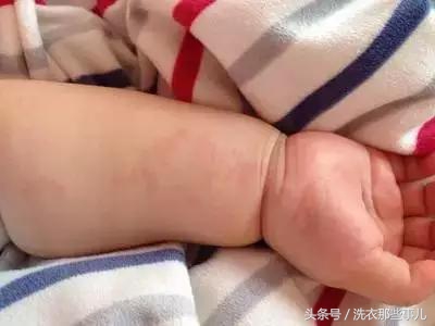 宝宝容易皮肤过敏是因为什么原因,宝宝皮肤过敏起疹子怎么解决