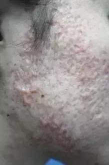 痘坑激光治疗视频,像素激光祛痘坑