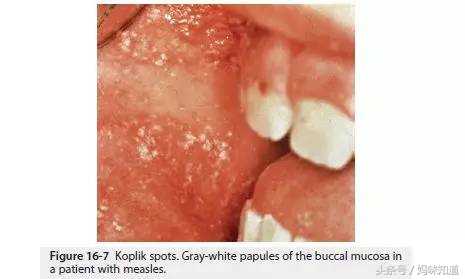 香港麻疹预防,香港麻疹病症