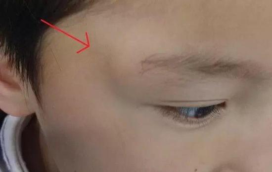 枕部表皮囊肿是怎么回事,表皮囊肿是如何形成的呢