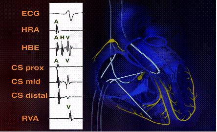 射频消融手术是怎样的,室上速射频消融术后如何护理