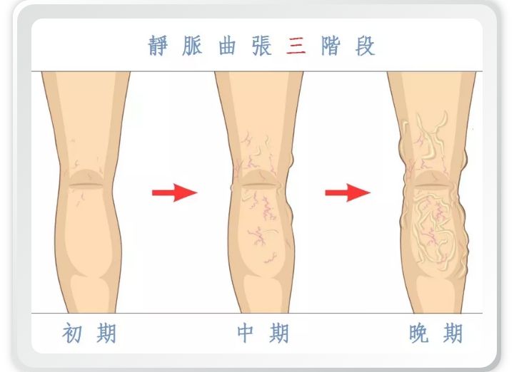 静脉曲张你了解多少,静脉曲张怎么治最好