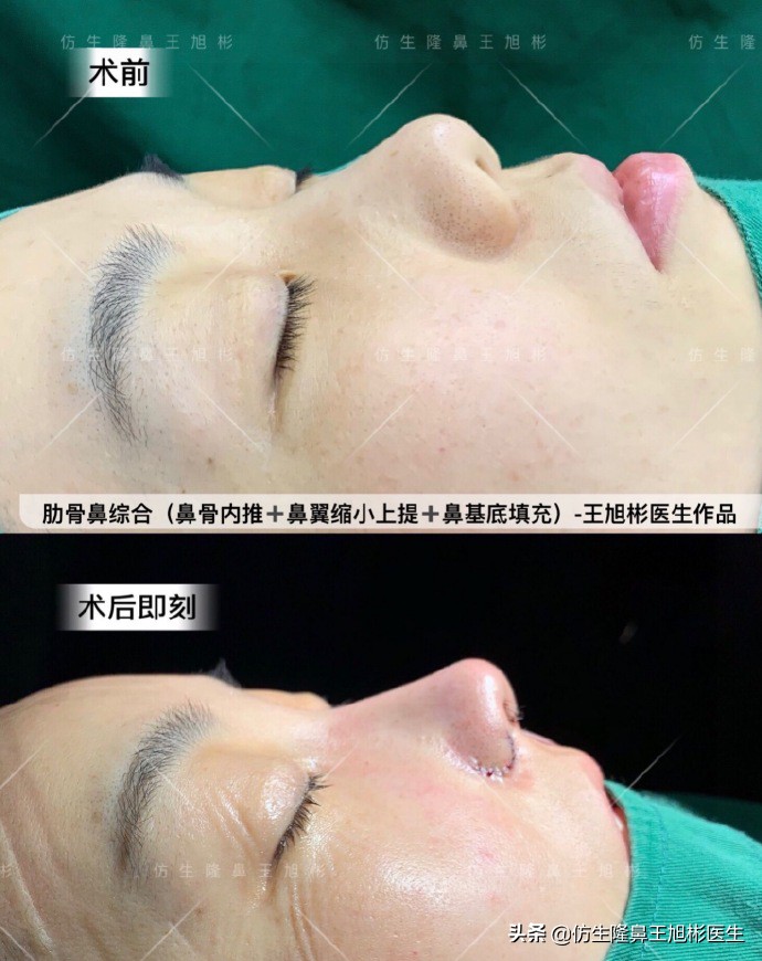 短鼻延长,短鼻塌鼻可以逆袭变长吗