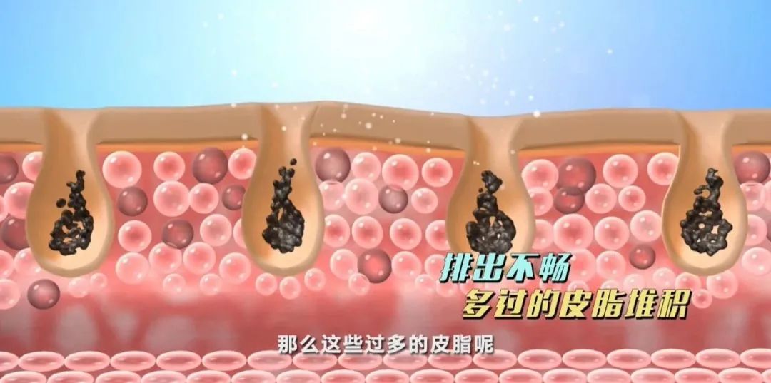 黑头成因及对策全攻略,黑头的形成原因你知道吗