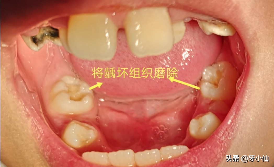 小孩子吃多了糖长虫牙,吃糖果不刷牙会有虫牙吗