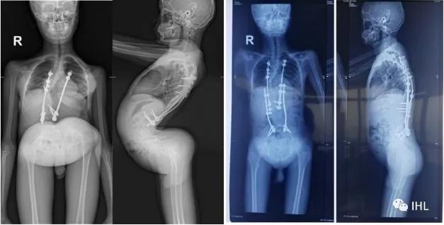 美国顶尖小儿骨科专家——DavidRoye教授已到我院工作