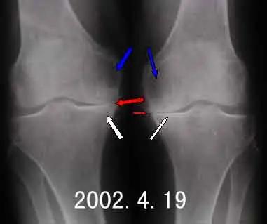 膝关节骨性关节炎到底该怎么治？这篇全说透了
