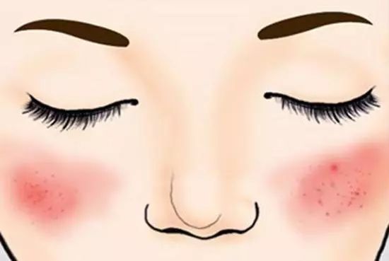 女明星皮肤过敏,女明星过敏发作