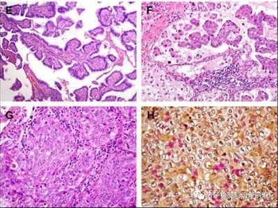肺癌！已经发了CT诊断报告，还有必要做穿刺？不算重复吗？