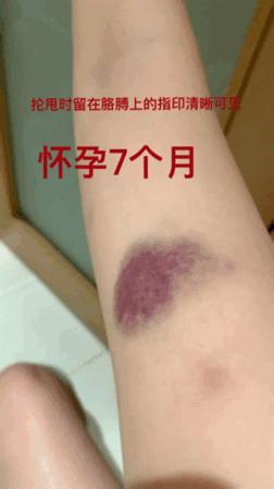 短跑名将张培萌家暴事件,短跑名将张培萌殴打岳母视频