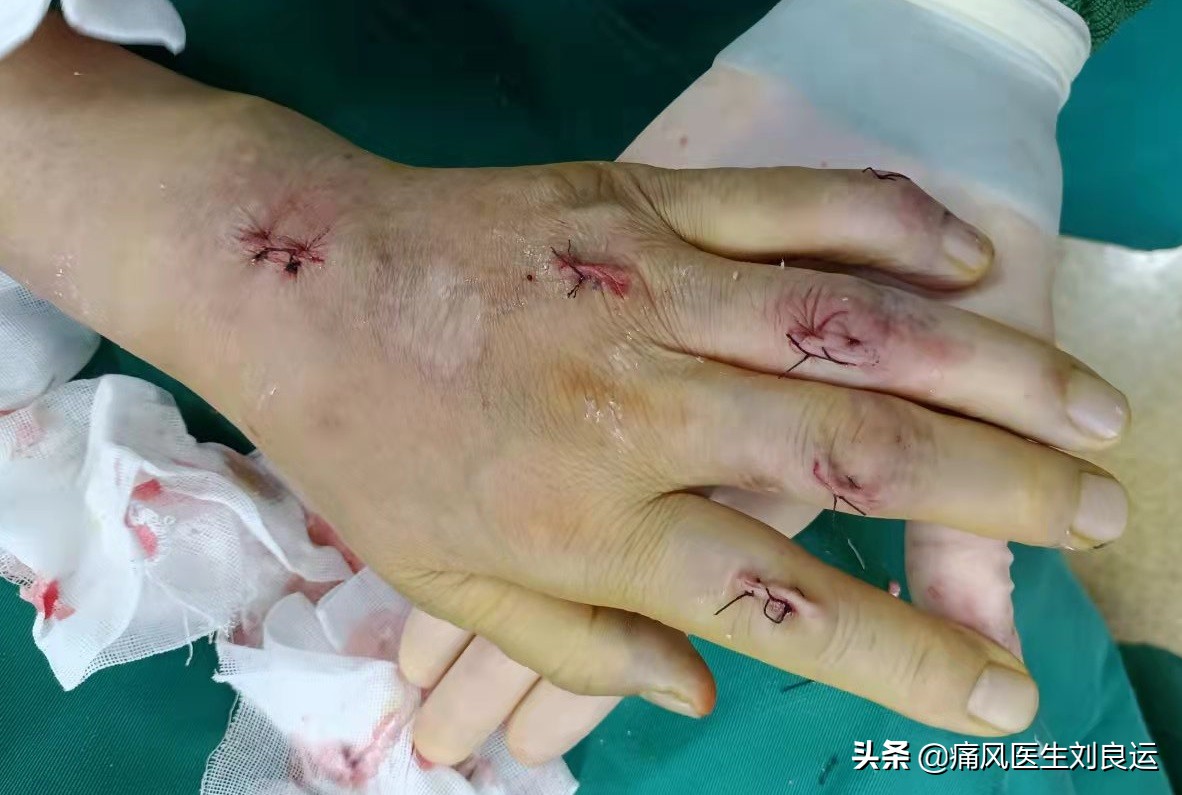 我和我20多年的婚姻，因为痛风20年的丈夫长出痛风石遭遇考验