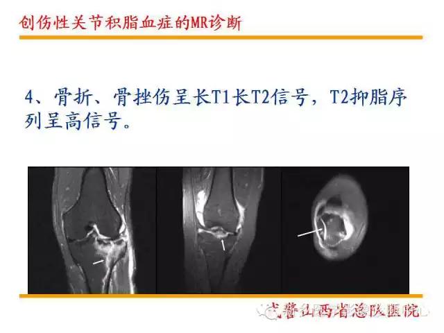 膝关节炎髌上囊积液自己看得出吗,髌上囊有积液膝盖会走路无力吗
