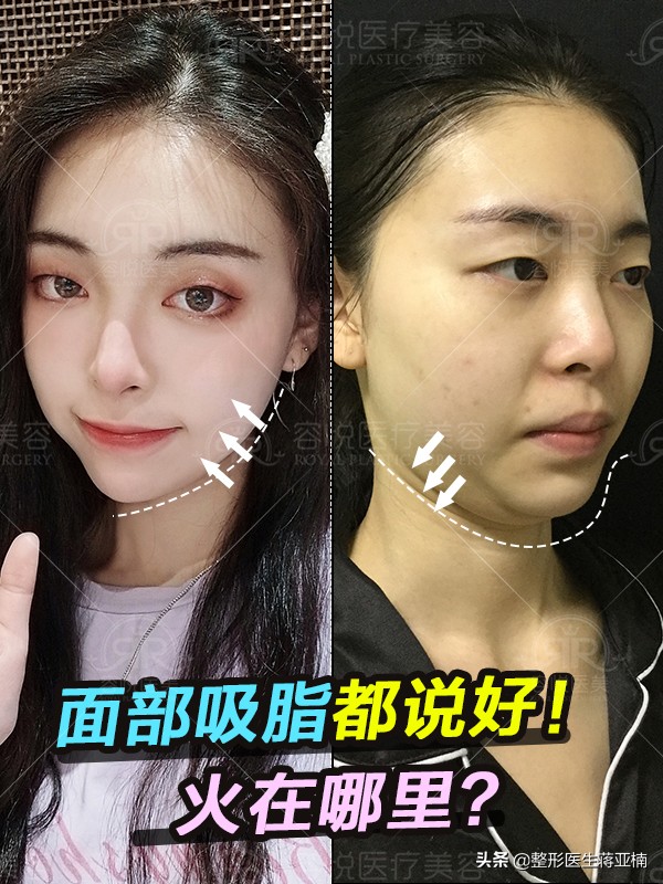 面部吸脂后如何快速消肿,面部吸脂去哪做