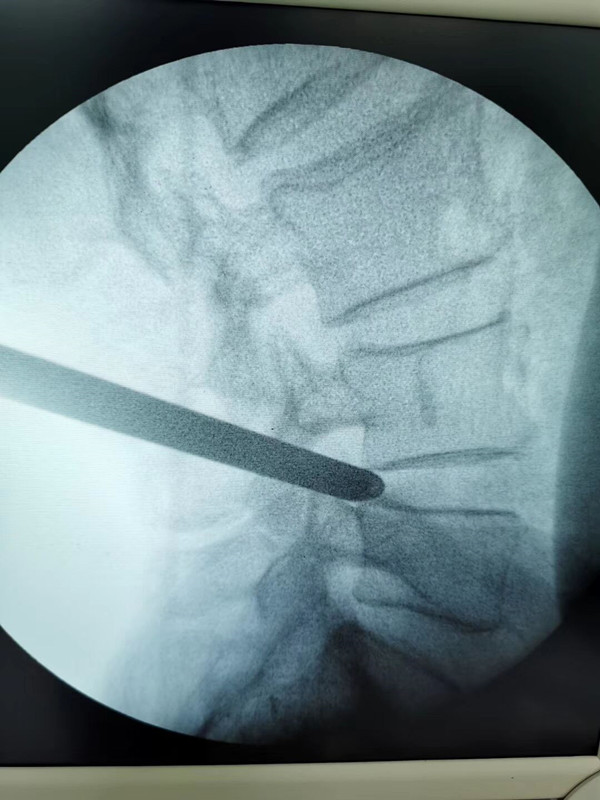 腰椎间盘突出6毫米怎么保守治疗,腰椎间盘突出6毫米左右