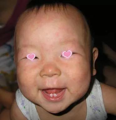 春天，宝宝皮疹的高发期！家长看看怎么辨别皮疹和护理！