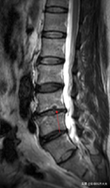 腰椎间盘突出最好的影像诊断方法,腰椎间盘突出的影像学检查
